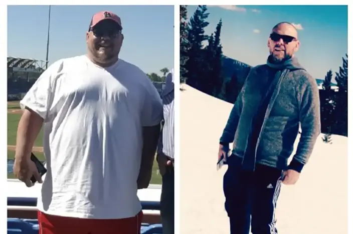 Overweight-Man-Before-and-After-Surgery