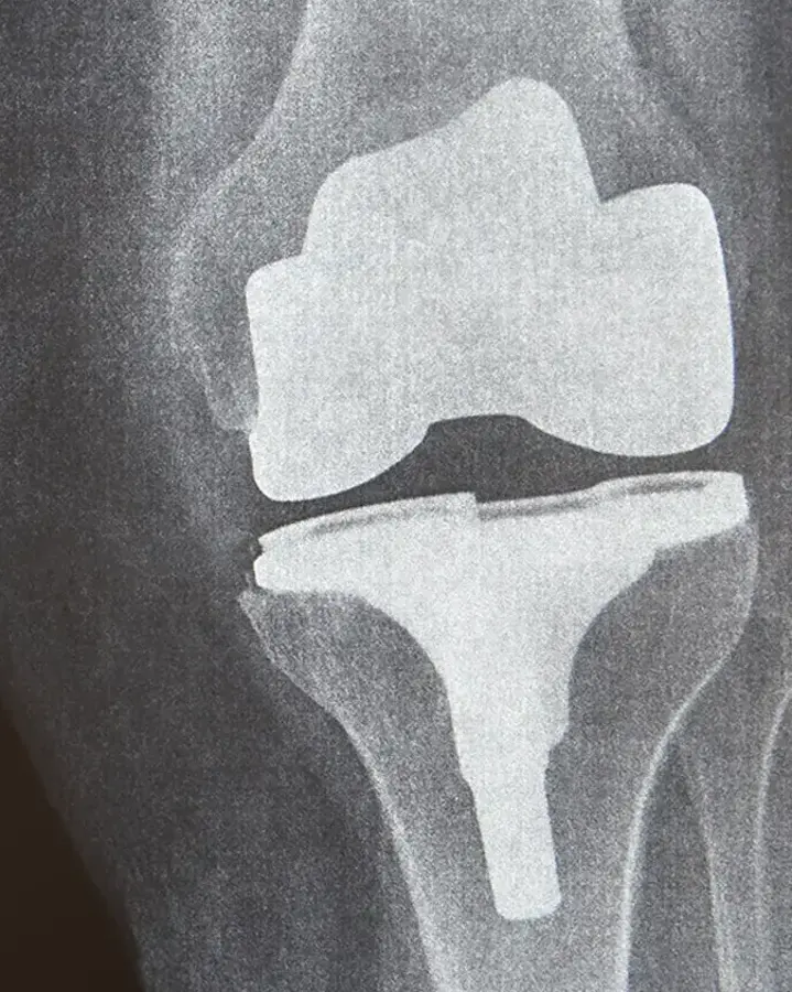 x-ray of a knee